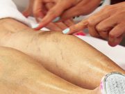 varices jambes personnes âgées