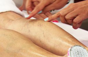 varices jambes personnes âgées