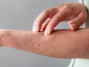 Brulures de la peau : que faire en cas d’atteinte, quels risques ? Brulures des seniors
