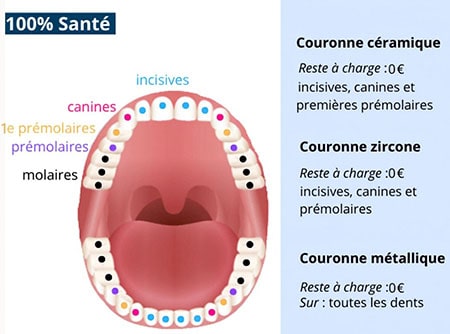 Couronne dentaire 100 Sante