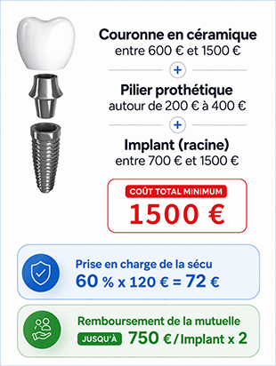 Prix implant dentaire complet
